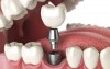 Trồng răng Implant là quá trình cấy trụ titanium vào trong xương hàm thay thế cho răng đã mất