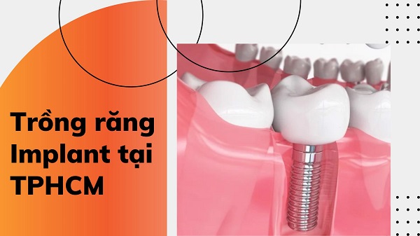 Top 12 địa chỉ trồng răng Implant tại TPHCM